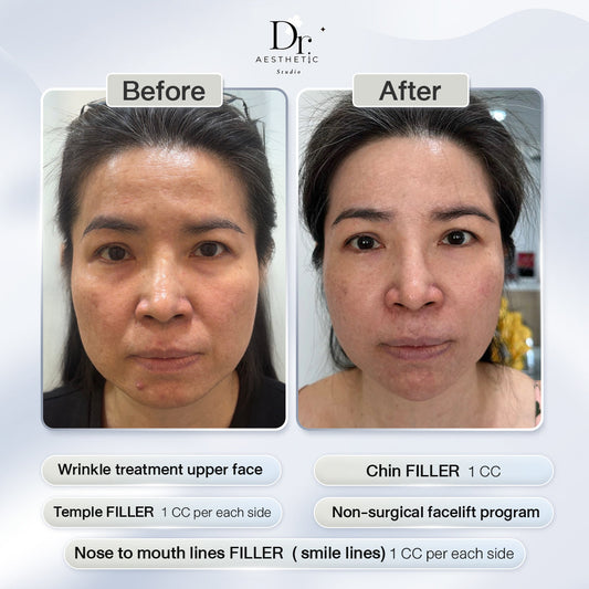 Review Wrinkle treatment
