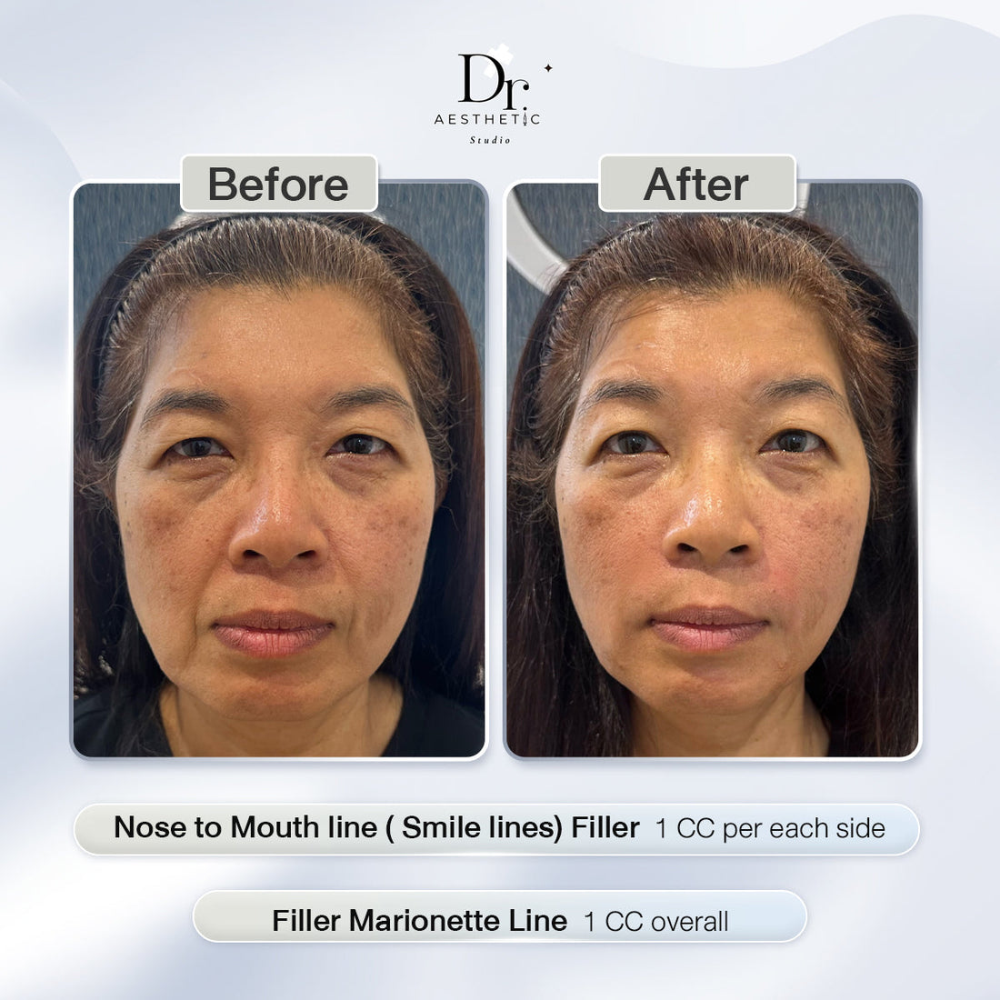 Review Smile lines filler