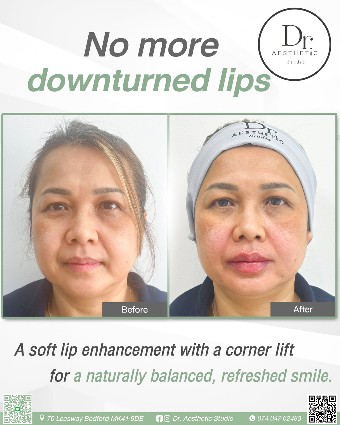 Lip filler| A soft lip enhancement with a corner lift for a naturally balanced, refreshed smile