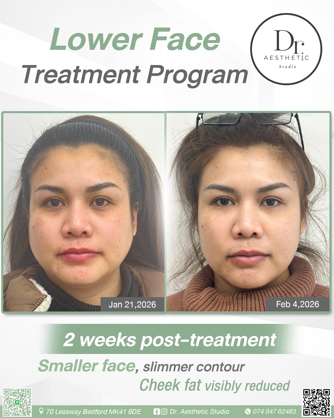 Lower Face Treatment Program in Bedford