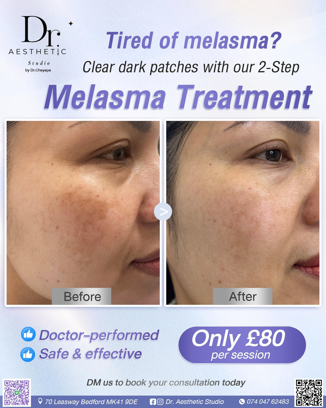 Clear dark patches with 2 step | Melasma Treatment