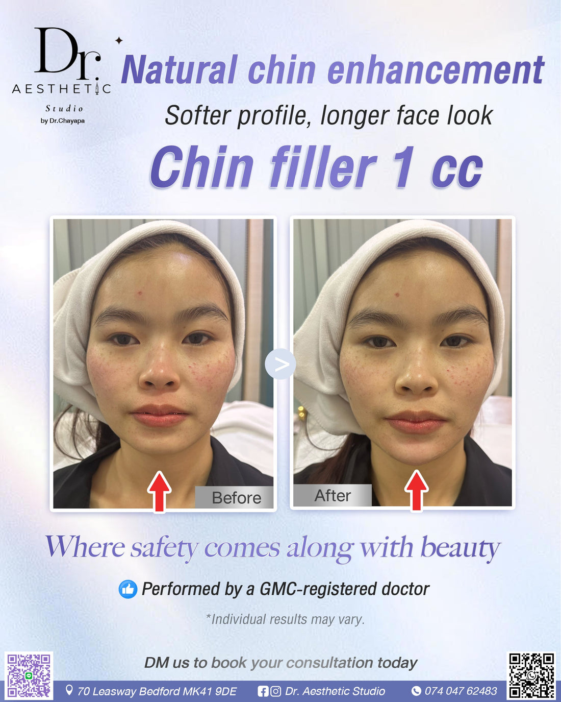 Chin Filler Dr. Aesthetic Studio Bedford
