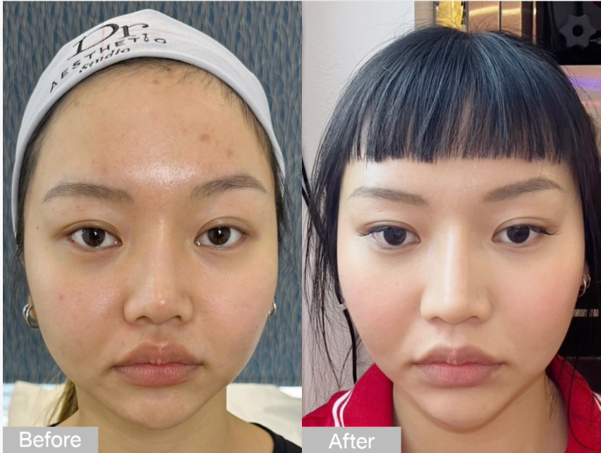 Lower Face Treatment Programme