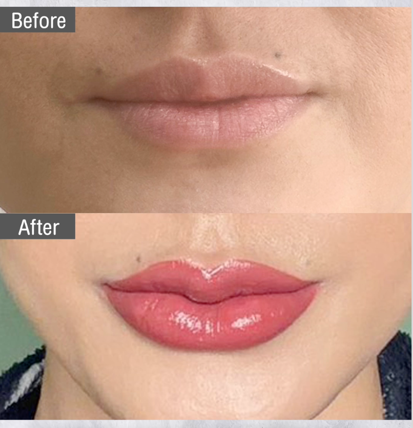 Lip filler isn’t about bigger lips. It’s about better lips. 💋