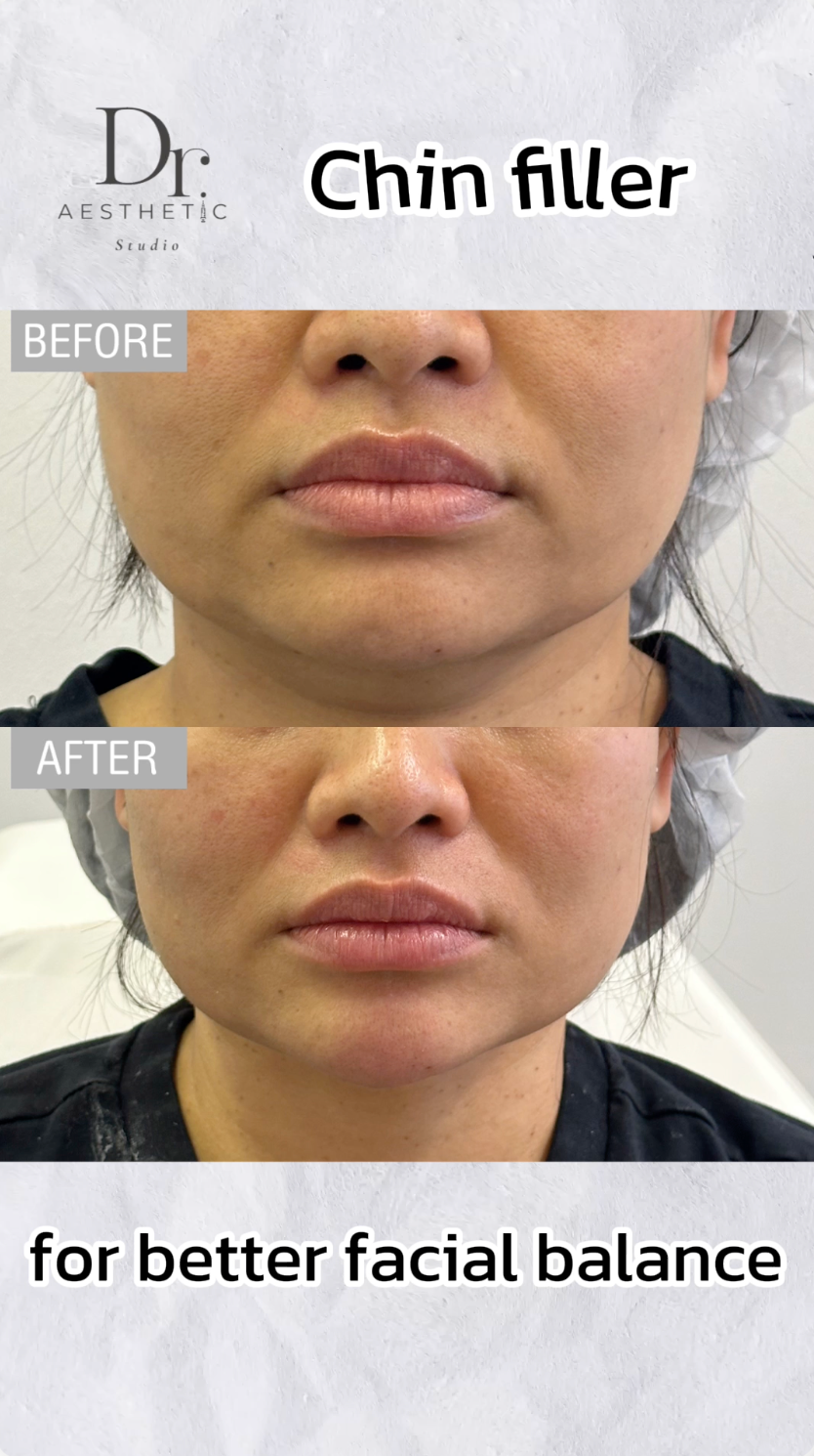 Chin filler | Dr. Aesthetic Studio Bedford