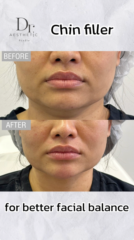 Chin filler | Dr. Aesthetic Studio Bedford