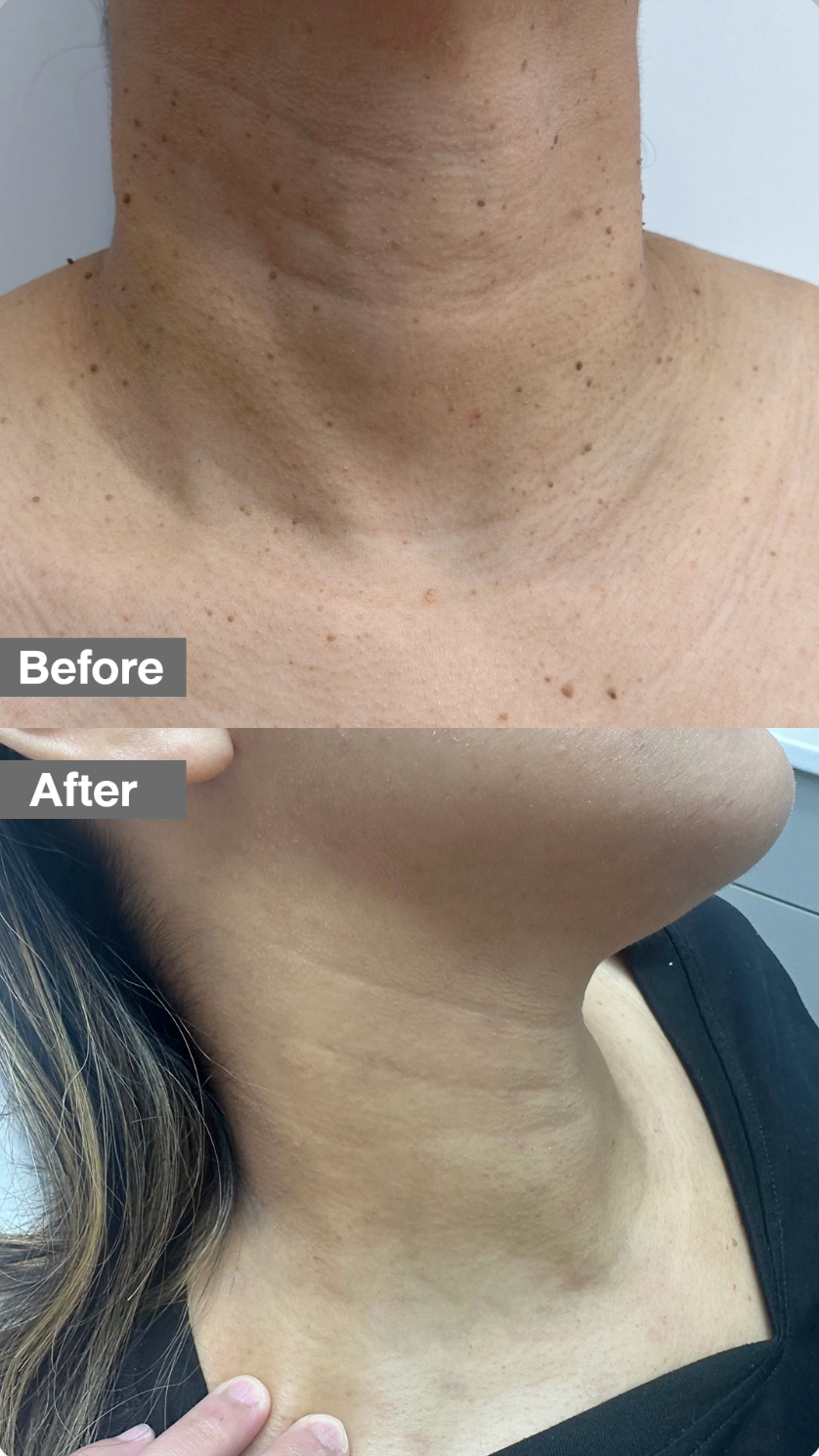 Remove unwanted skin tags and harmless skin growths with a quick