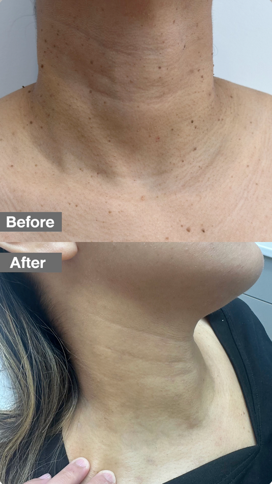 Remove unwanted skin tags and harmless skin growths with a quick