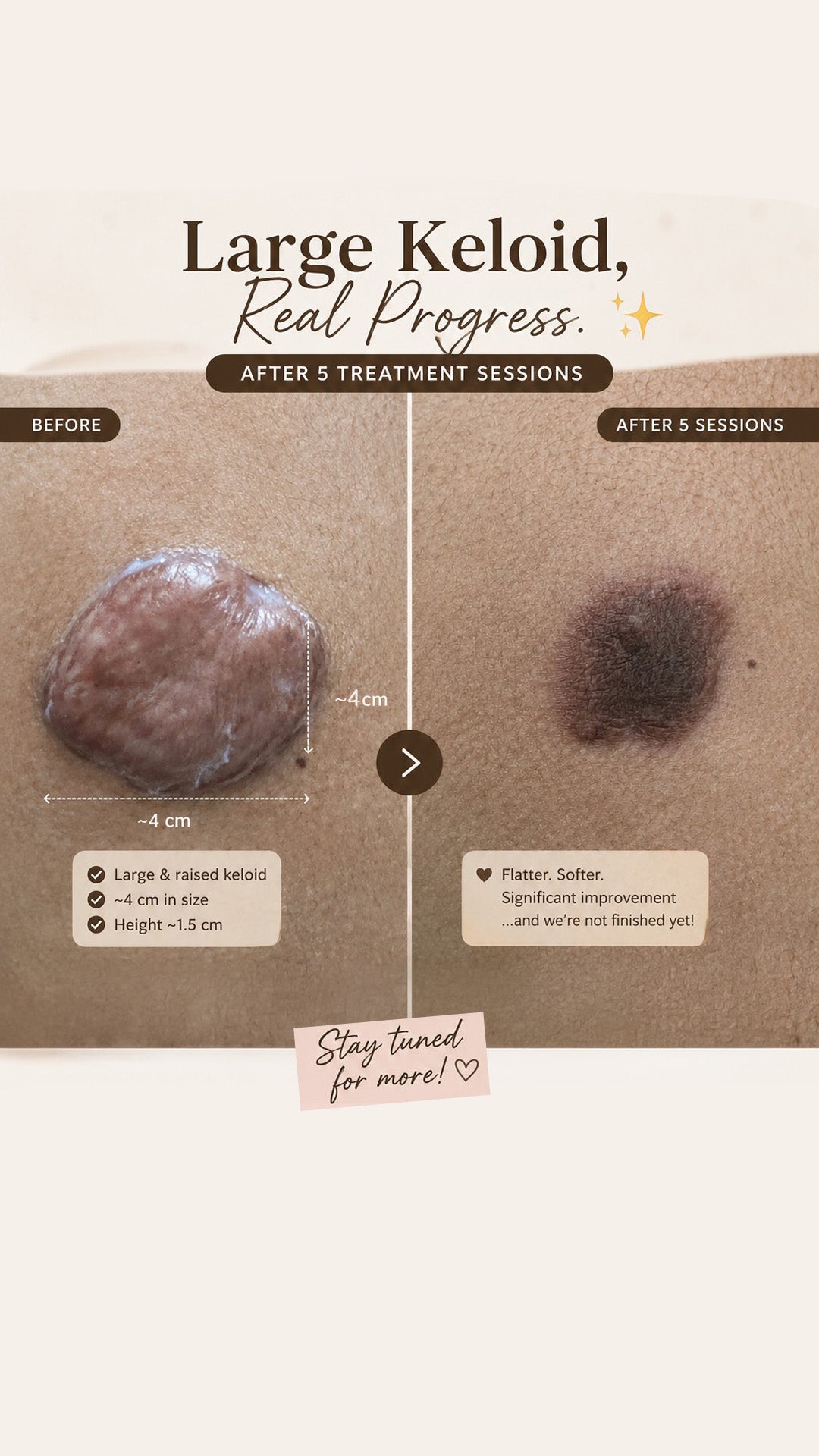 Living with a keloid can be frustrating—but don’t lose hope. 🤍