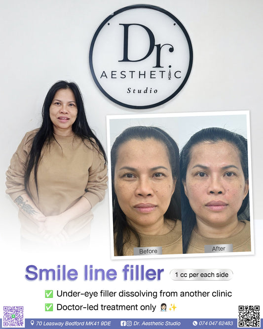 Smile line filler Dr. Aesthetic Studio Bedford