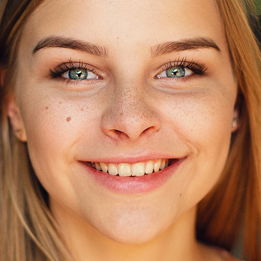 Melasma Clear 1 Session